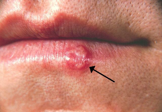 What is herpes? Is herpes contagious?